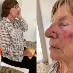 Cruel asalto en Mar del Plata dejó a una mujer de 82 años con varios dientes menos tras ser golpeada en el rostro